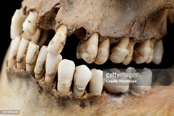 very bad teeth indeed - human jaw bone stockfoto's en -beelden