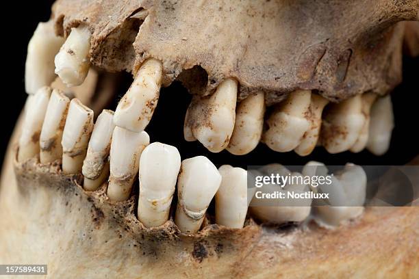 very bad teeth indeed - human jaw bone stock pictures, royalty-free photos & images