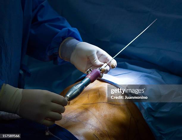 liposuction suction probe - liposuction stock pictures, royalty-free photos & images