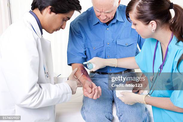 médecin et infirmière traitement homme blessé, à brûler. service des urgences de l'hôpital. - wounded photos et images de collection