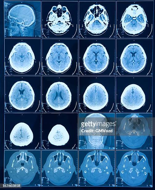mri brain scan - mri scan medische scan stockfoto's en -beelden