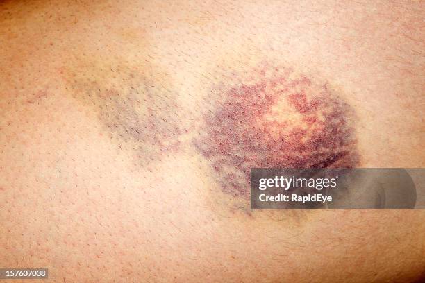 close up of bruised skin on human leg - hemorrhage stock pictures, royalty-free photos & images