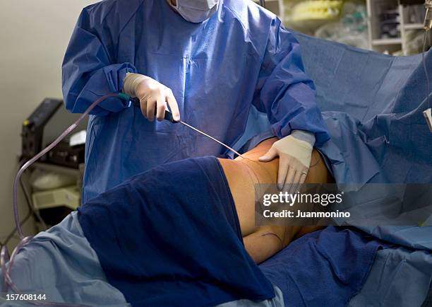 liposuction - liposuction stock pictures, royalty-free photos & images