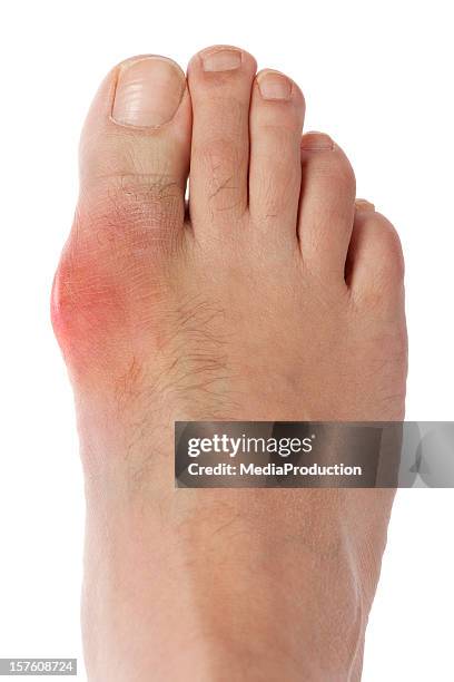 gout foot - gout stockfoto's en -beelden