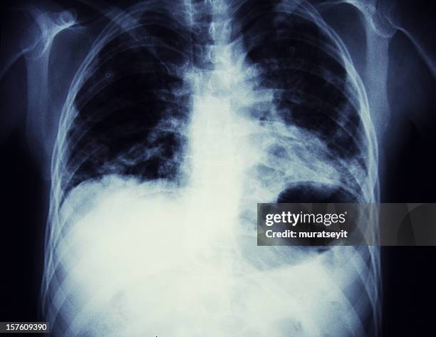 x-ray of a lunge cancer - lung cancer stockfoto's en -beelden