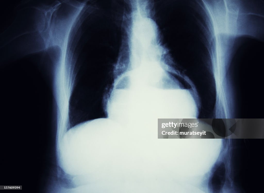 Hernia of the stomach
