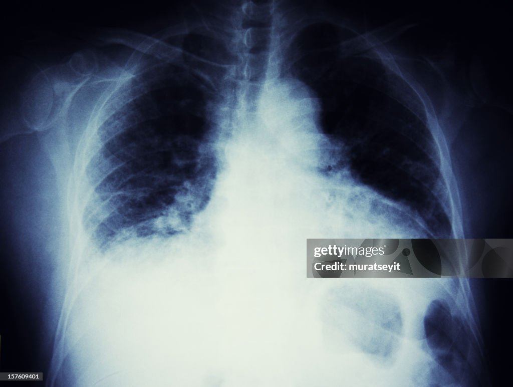 X-ray of a smoking man