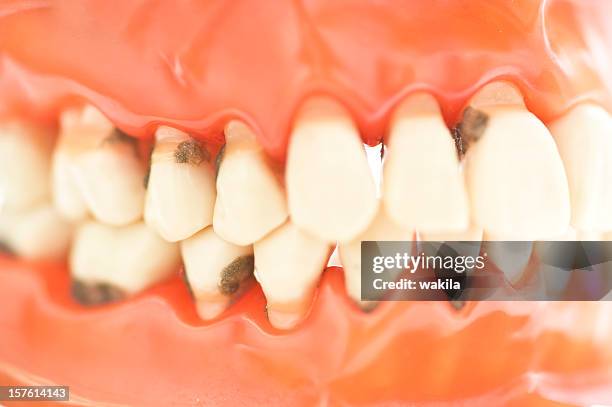 set of teeth with caries macro picture - zähne karies - rotten teeth from not brushing stockfoto's en -beelden