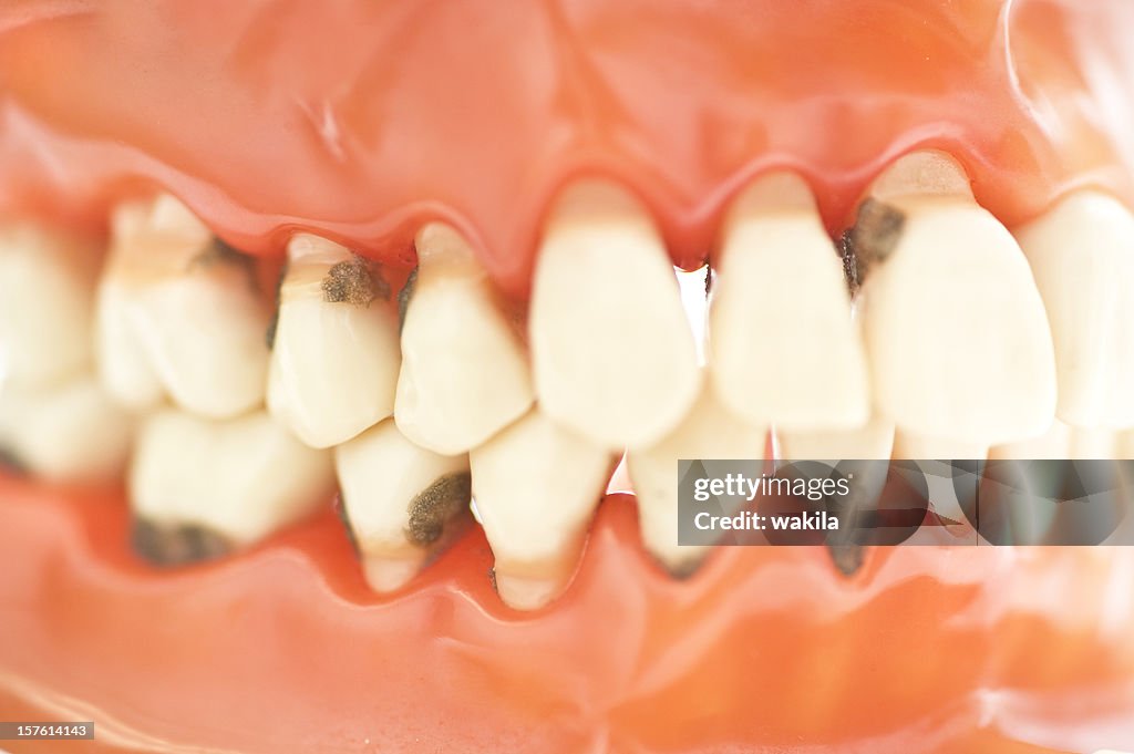 Set of teeth with caries macro picture - Zähne Karies