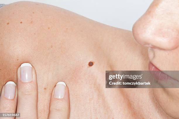 cáncer de piel - dermatología fotografías e imágenes de stock