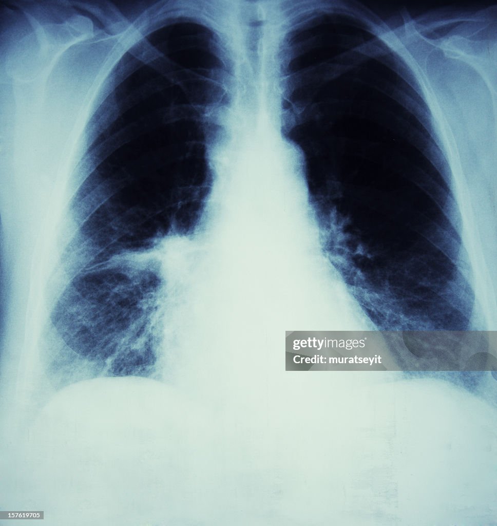 X-ray de un cáncer de la gripe la sala de estar y