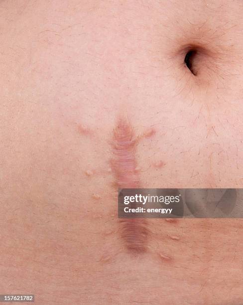 skin scar - keloïd stockfoto's en -beelden