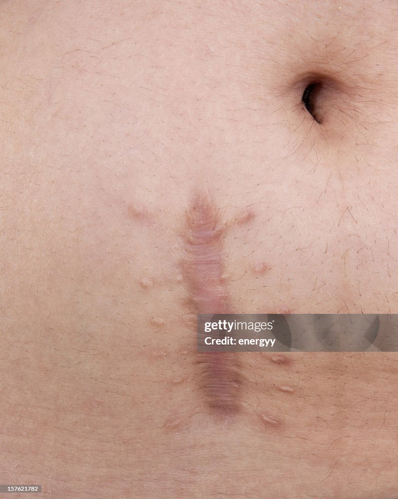 Skin scar