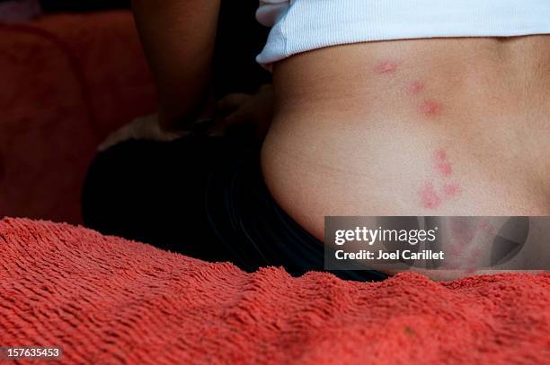 femme assise sur le lit avec une punaise de lit en-cas - punaise photos et images de collection