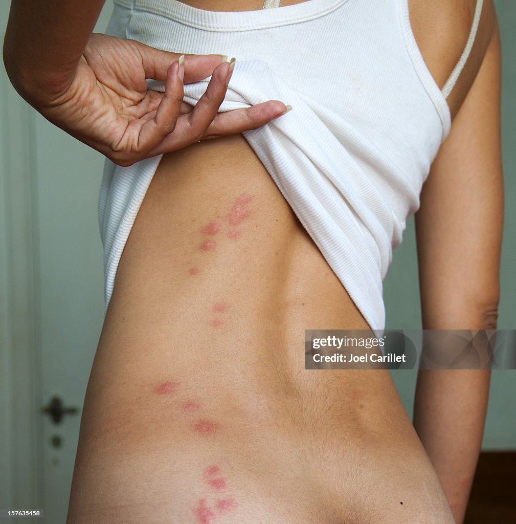 Bedbug bites revealed under woman's shirt