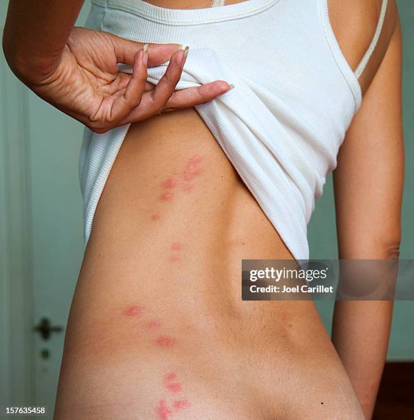 bedbug bites revealed under woman's shirt - woman bumps stock pictures, royalty-free photos & images
