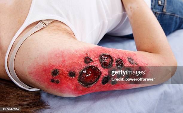 third degree charred flame burn - burns victims stock pictures, royalty-free photos & images