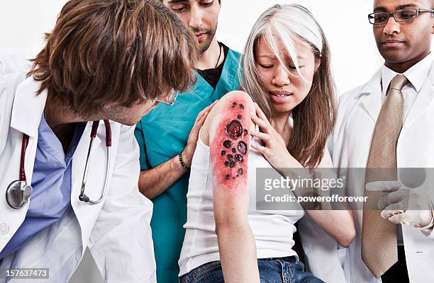 medical team examining burn victim - burns victims stock pictures, royalty-free photos & images