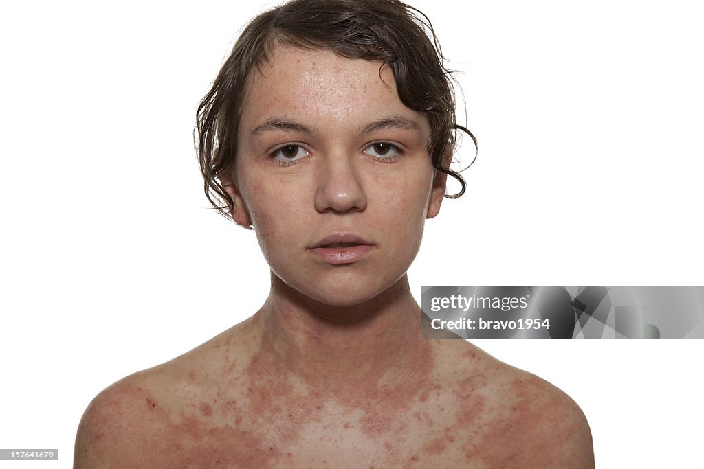 Atopic dermatitis