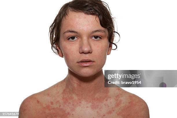 atopic dermatitis - eczema stock pictures, royalty-free photos & images