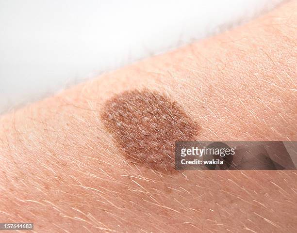 mol mancha hepática birthmark en piel humana-leberfleck - cáncer de la piel fotografías e imágenes de stock
