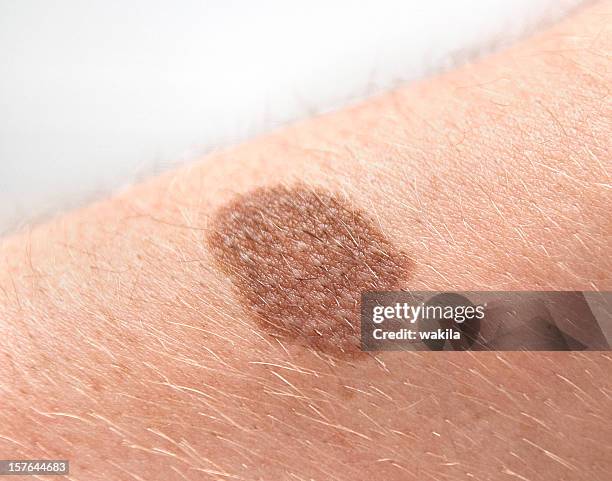 mole liver spot birthmark on human skin - leberfleck - mole stockfoto's en -beelden