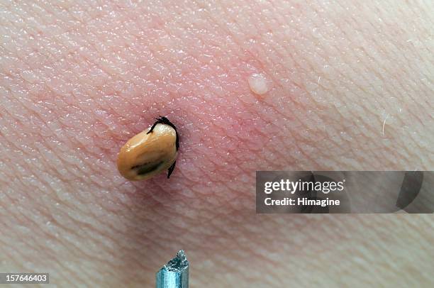 human tick - lyme disease bite stockfoto's en -beelden