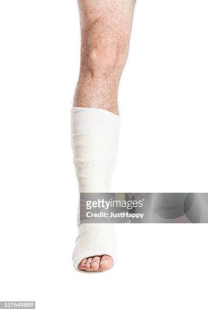 broken leg in cast, isolated on white - twisted ankle stock pictures, royalty-free photos & images