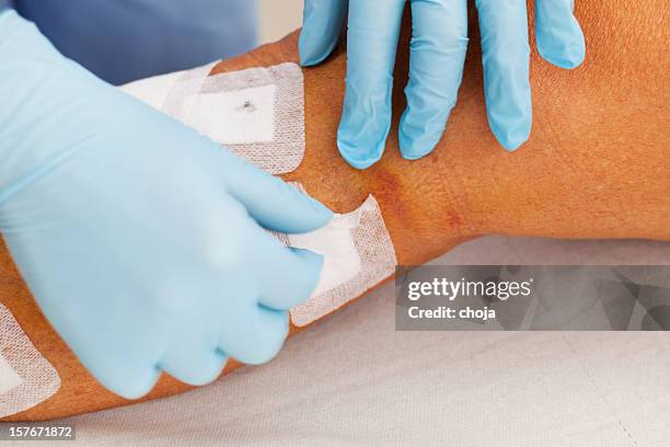 nurse is taking care of patient after vein stripping - varicose vein stock pictures, royalty-free photos & images