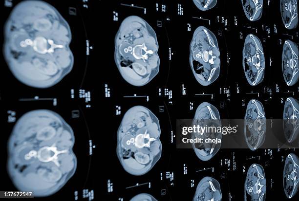 cat scan of human abdomen - mri abdomen stock pictures, royalty-free photos & images