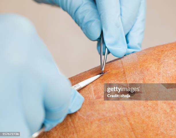 krankenschwester kümmert sich um patienten nach vene trennen - krampfader stock-fotos und bilder