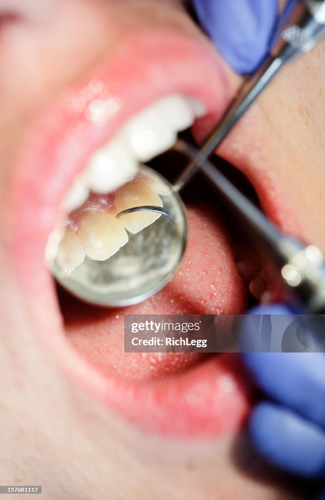 Dental Cleaning Close-up