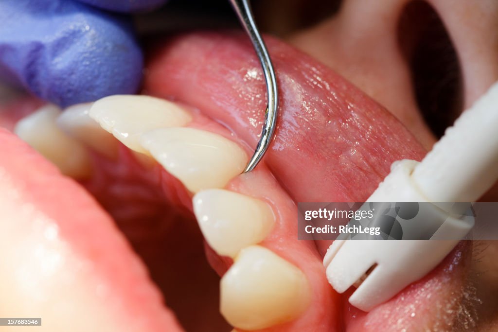 Dental Cleaning Close-up