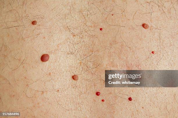 skin problems - moles, cherry angiomas, cysts and surgery scar - lentigo stockfoto's en -beelden