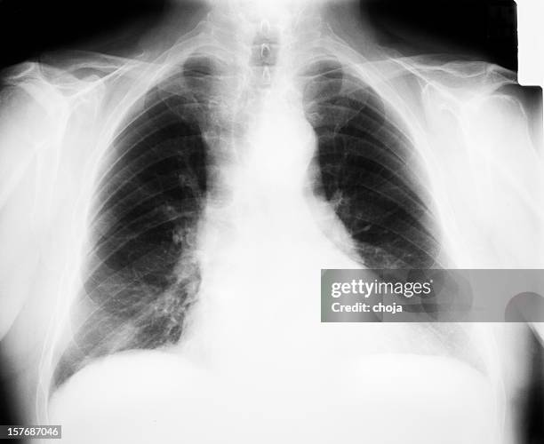 298 Heart Chest Xray Stock Photos High Res Pictures and Images 298 Heart Chest Xray Stock Photos High Res Pictures and Images