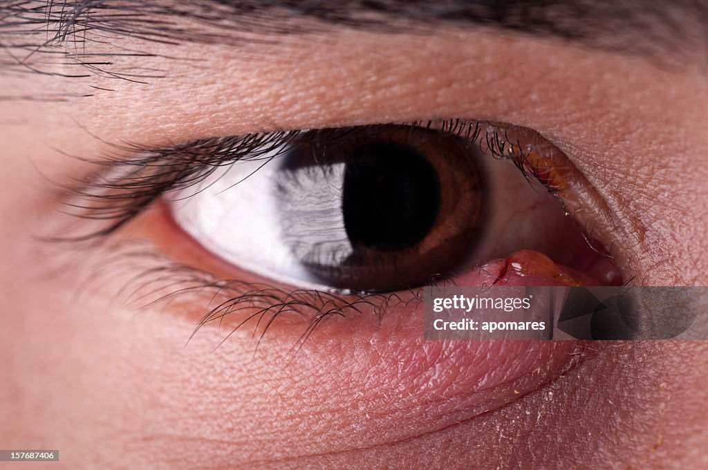 Stye - Eye Infection