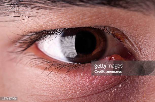 stye - eye infection - svullen bildbanksfoton och bilder