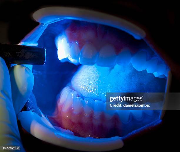dental treatment - dental composite stock pictures, royalty-free photos & images