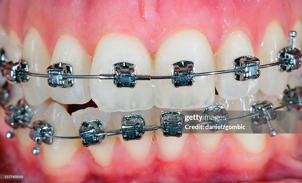 Orthodontic Treatment