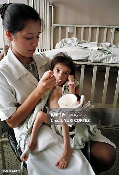 This 15 June 1999 file photo shows a three-year-old malnurished boy suffers of undernourishment that this being fed by a nurse in the pediatric...