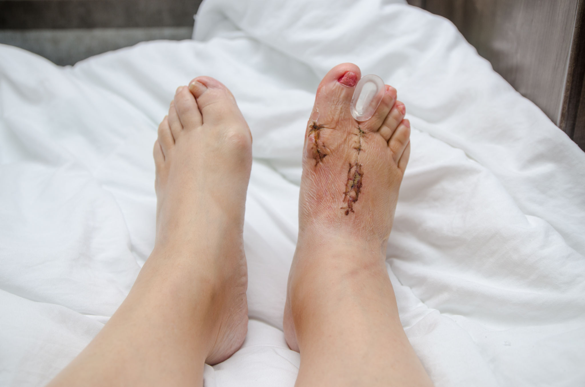 bunion surgery