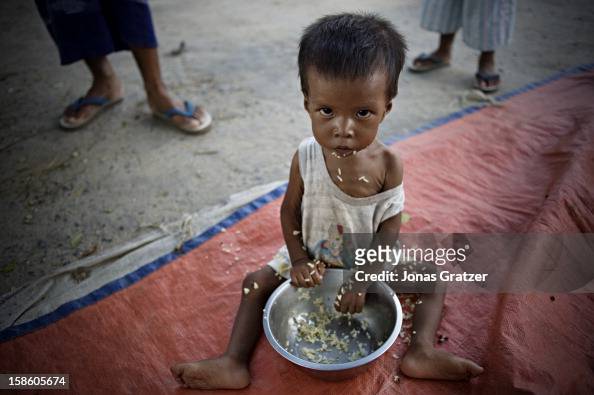 A malnourished child having a meal of rice. Despite large...