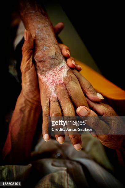 Wounded hand of a victim of an acid attack. In the recent years, acid attacks become prominent issues in Cambodia. Whether it is a revenge for love...