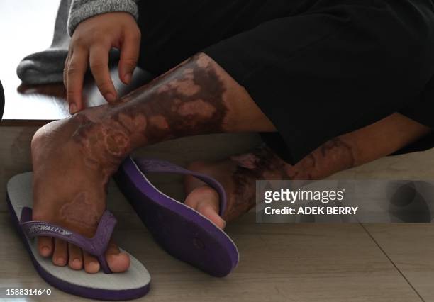 This picture taken on July 27, 2023 shows scars from the physical abuse Siti Khotimah suffered by her employer while working as a domestic worker,...