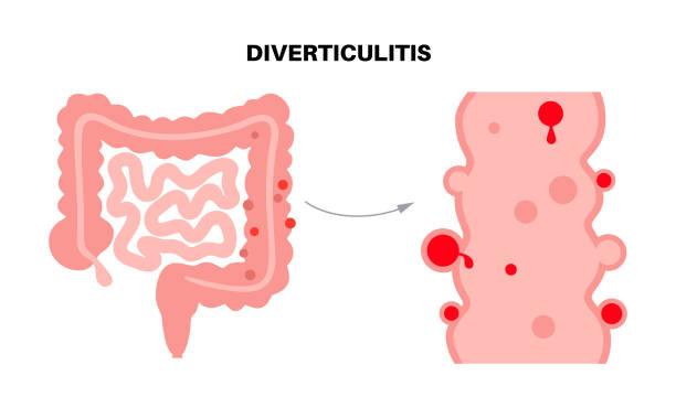 Diverticulitis and diverticulosis stock illustrations