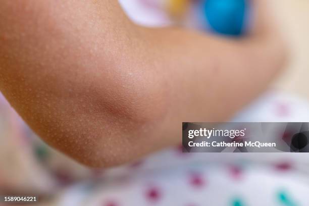 young multiracial female with large swollen mosquito bite on arm - lyme disease bite stockfoto's en -beelden