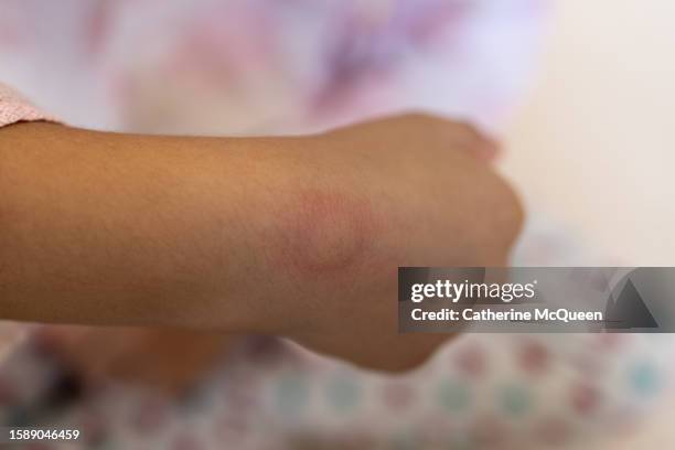 young multiracial female with large swollen mosquito bite on arm - lyme disease bite 個照片及圖片檔