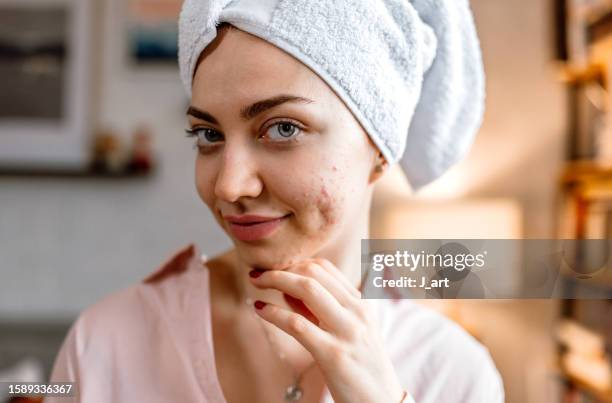 face care. - acne stock pictures, royalty-free photos & images