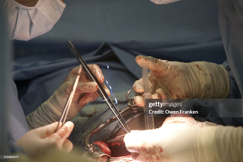 Surgeons at work during a kidney tranplant