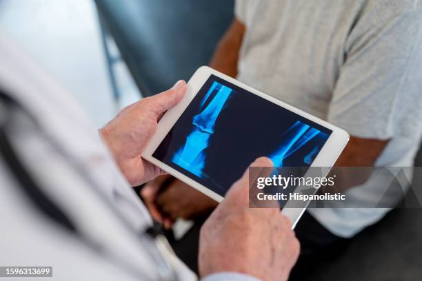 nahaufnahme eines nicht erkennbaren orthopäden, der ein röntgenbild eines älteren patienten auf einem digitalen tablet betrachtet - knochenbruch stock-fotos und bilder